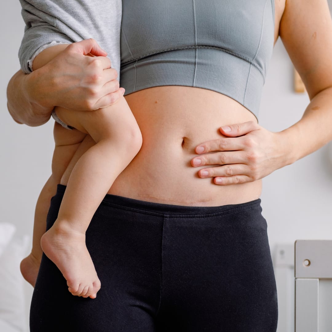 Postpartumhoivan sektioarven hoito on tarkoitettu sektiolla synnyttäneille äideille.